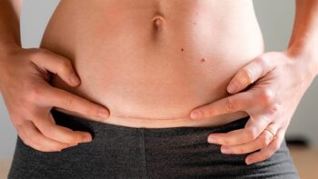 Quanto tempo a barriga volta ao normal depois do parto cesárea?