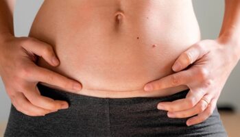 Quanto tempo a barriga volta ao normal depois do parto cesárea?