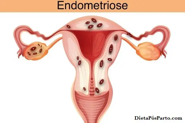 Como é feito o diagnóstico da endometriose