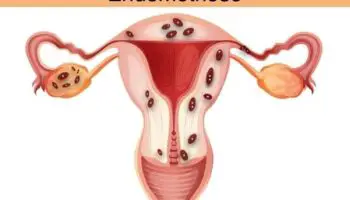 O que é Endometriose na Cicatriz da Cesárea